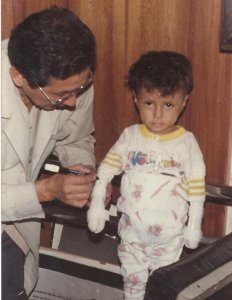 Niño amputado de los miembros superiores, con una prótesis temporal de ayuda a su rehabilitación en la vida diaria